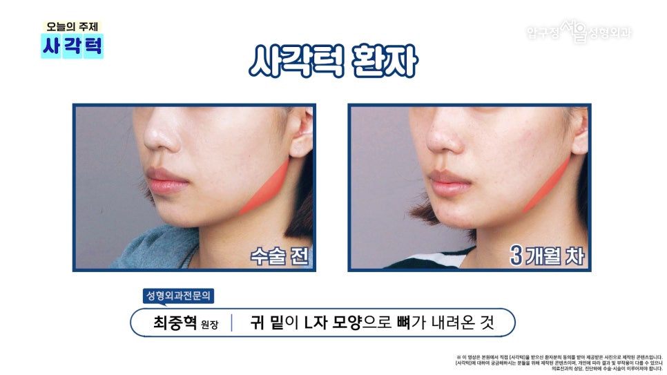 압구정 안면윤곽 사각턱, 광대, 턱끝 개념과 종류 수술방법 압구정서울성형외과 관련 이미지 8