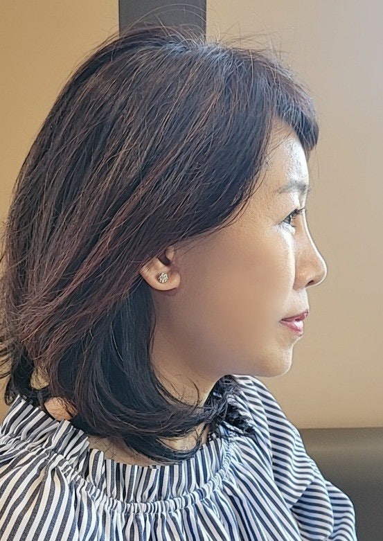 [압구정서울성형외과] 50대 이마거상, 안면거상, 하안검 후기 관련 이미지 6