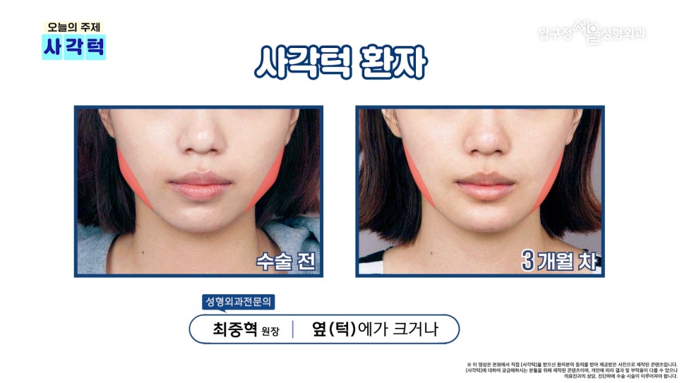 압구정 안면윤곽 사각턱, 광대, 턱끝 개념과 종류 수술방법 압구정서울성형외과 관련 이미지 7