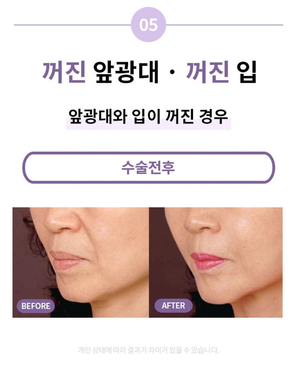 "SMAS Facelift" to Firmly Restore Sagging Jowls and Nasolabial Folds image 9