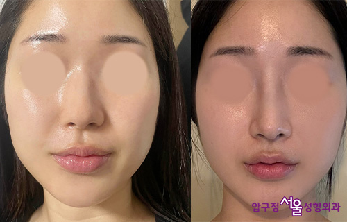 Natural Rhinoplasty Review for a Hump Nose with Septal Deviation in Apgujeong image 2
