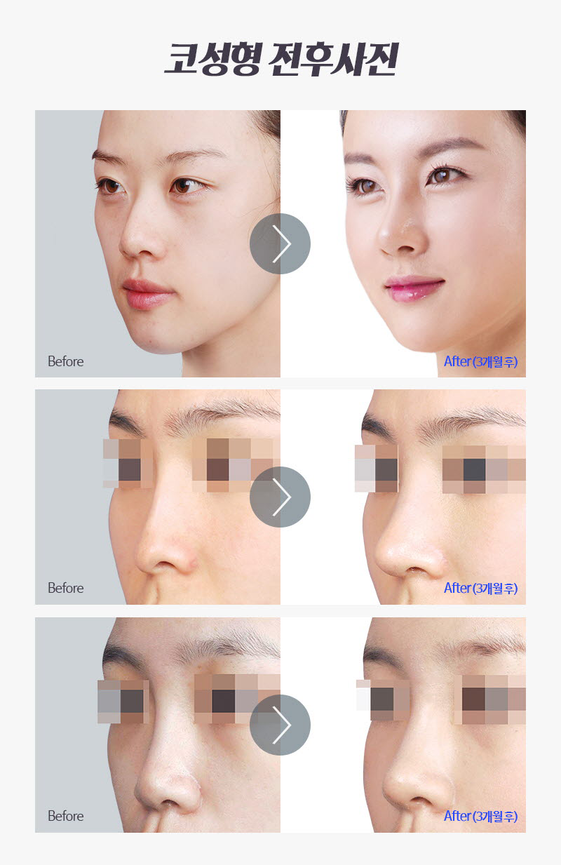 눈 성형보다 코 성형 회복이 훨씬 빠르다는 사실! 관련 이미지 7