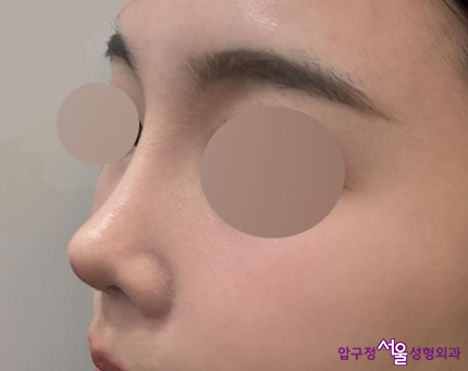압구정서울성형외과 수험생 낮은코, 복코성형 후기 관련 이미지 4