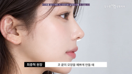 기능코수술 압구정서울성형외과 코막힘과 코 모양을 함께 고려한다면 관련 이미지 7