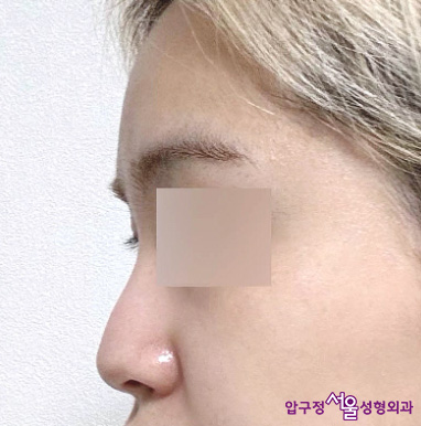 Apgujeong Plastic Surgery Review: Improved Hump Nose with a Straight Nose Line image 1