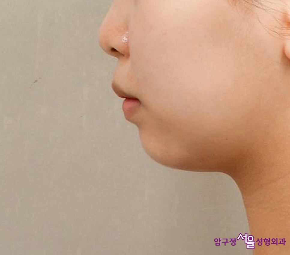 Chin Implant Surgery, a More Definitive Effect Than Fillers image 2