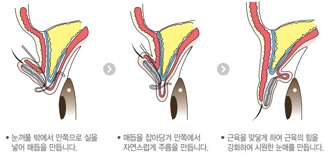 [Apgujeong Seoul Plastic Surgery] Non-incisional Eye Correction for Clearer, More Defined Eyes image 3