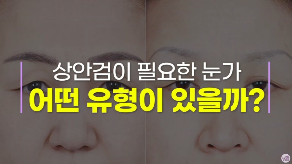 [Aging Eye Plastic Surgery in Apgujeong] Upper and Lower Blepharoplasty for a Youthful Eye Appearance! image 2