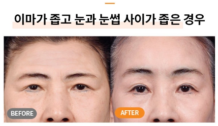 Worried About Forehead Wrinkles? A Quick Overview of Men’s Forehead Lifts and Forehead Lift Surgery Costs image 9