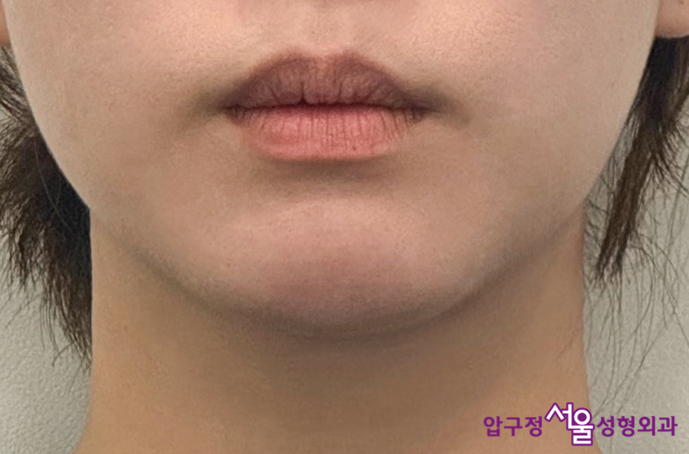 What Is a Retruded Chin? Chin Implant Surgery for Chin Correction at Apgujeong Seoul Plastic Surgery image 14