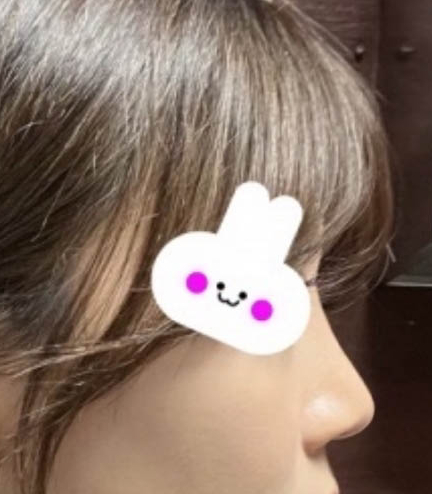 Apgujeong Bulbous Nose and Straight-Bridge Line Rhinoplasty Review image 3