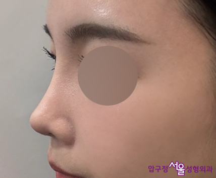 압구정서울성형외과 수험생 낮은코, 복코성형 후기 관련 이미지 5