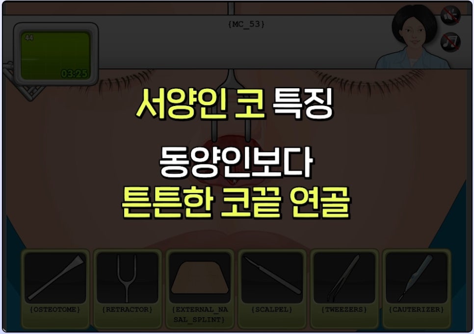 매부리코 코수술 게임 후기 및 비중격연골 매부리 코수술 방법 코수술 진행 과정 압구정서울성형외과 관련 이미지 18