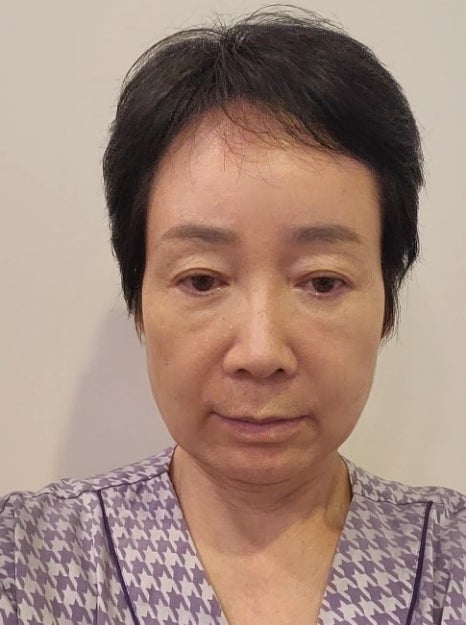 [Again, Youth Project] Consultation and Surgery Review for Facelift + Neck Lift in Your 60s ① image 10