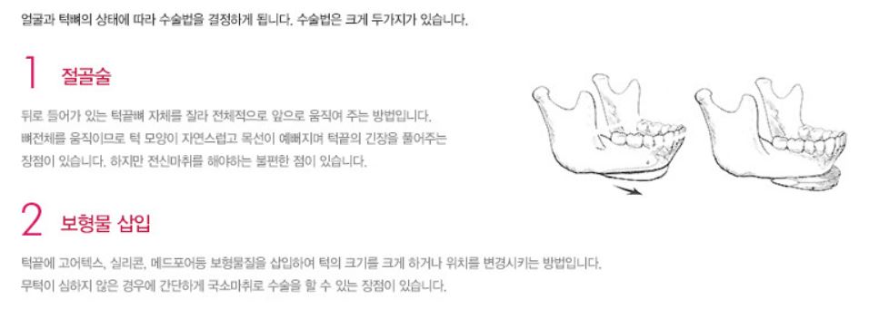 [윤곽성형] 무턱탈출, 이제 압구정서울성형외과에서! 관련 이미지 4