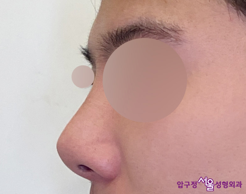 Apgujeong Plastic Surgery Nose Revision: Upturned Nose Causes and Surgery Review image 7