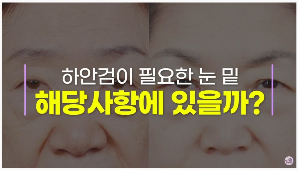 [Aging Eye Plastic Surgery in Apgujeong] Upper and Lower Blepharoplasty for a Youthful Eye Appearance! image 5
