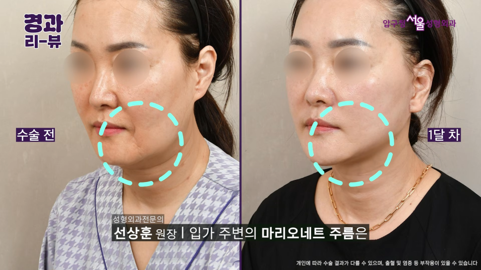 50대 안면거상 후기 팔자주름부터 목주름까지 어떻게 달라질까? 관련 이미지 8