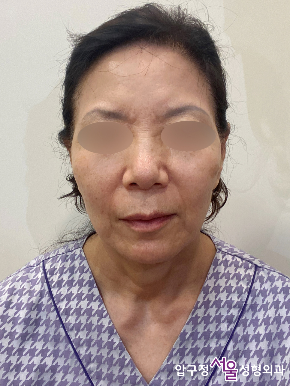 Curious About Reviews of a Clinic That Does Facelift Surgery Well at Apgujeong Seoul Plastic Surgery? image 4