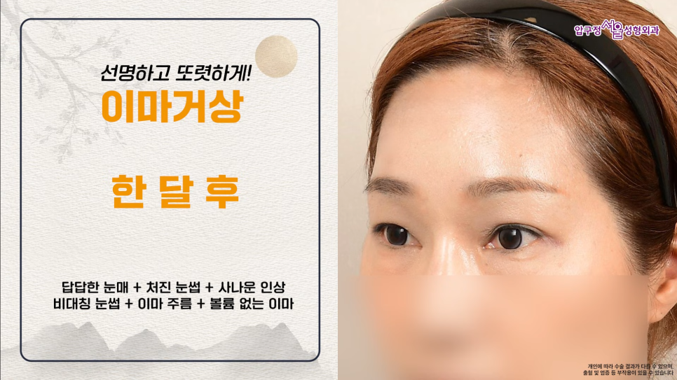 40대 이마거상수술 전후 궁금하다면? 내시경 이마거상술 체크포인트 관련 이미지 6
