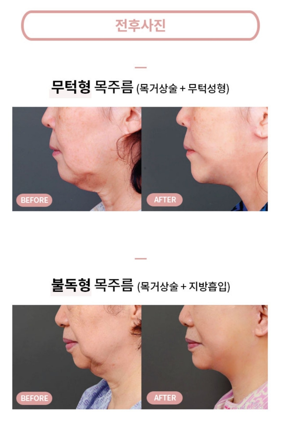 나이테같은 목주름을 확실히 당겨주는 방법은? "목거상술" 관련 이미지 4