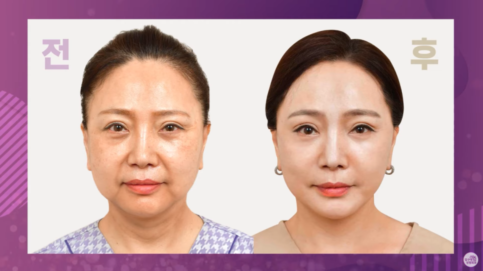 [안면거상술 - 동안성형] 압구정서울성형외과에 9년만에 찾아 온 인연! 관련 이미지 4
