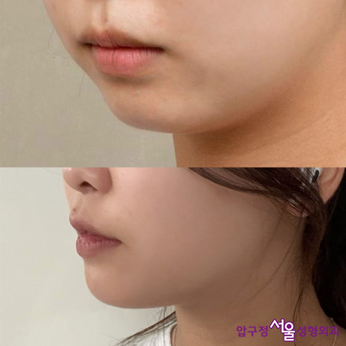 Chin Implant Surgery, a More Definitive Effect Than Fillers image 7
