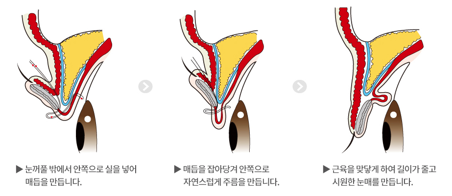눈매교정과 쌍수 똑같은 줄 아셨나요? 관련 이미지 3