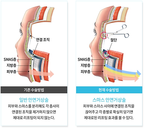 Curious About Reviews of a Clinic That Does Facelift Surgery Well at Apgujeong Seoul Plastic Surgery? image 1