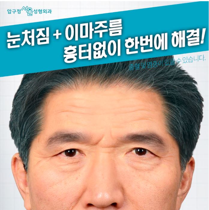 압구정서울성형외과 눈처짐+이마주름 한번에 해결! 관련 이미지 1