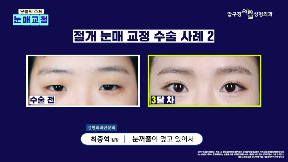 압구정서울성형외과 안검하수 수술 후기 비교│절개vs비절개 선택 기준 관련 이미지 6