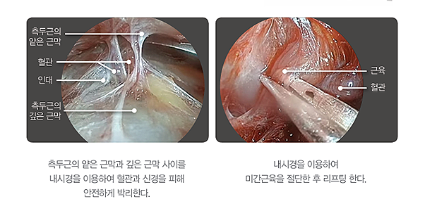 압구정서울성형 이마거상술로 이마주름 고민해결 후기 관련 이미지 3