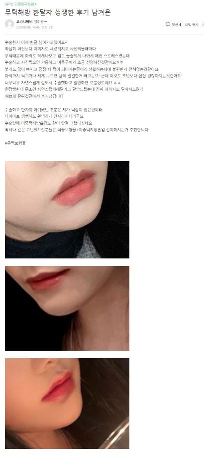 [윤곽성형] 무턱탈출, 이제 압구정서울성형외과에서! 관련 이미지 10