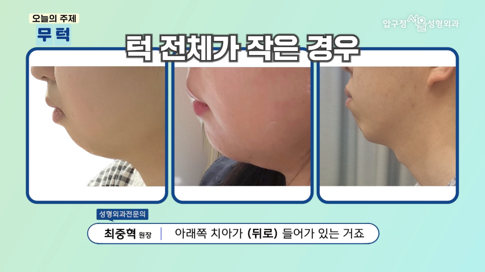 What Is a Retruded Chin? Chin Implant Surgery for Chin Correction at Apgujeong Seoul Plastic Surgery image 2