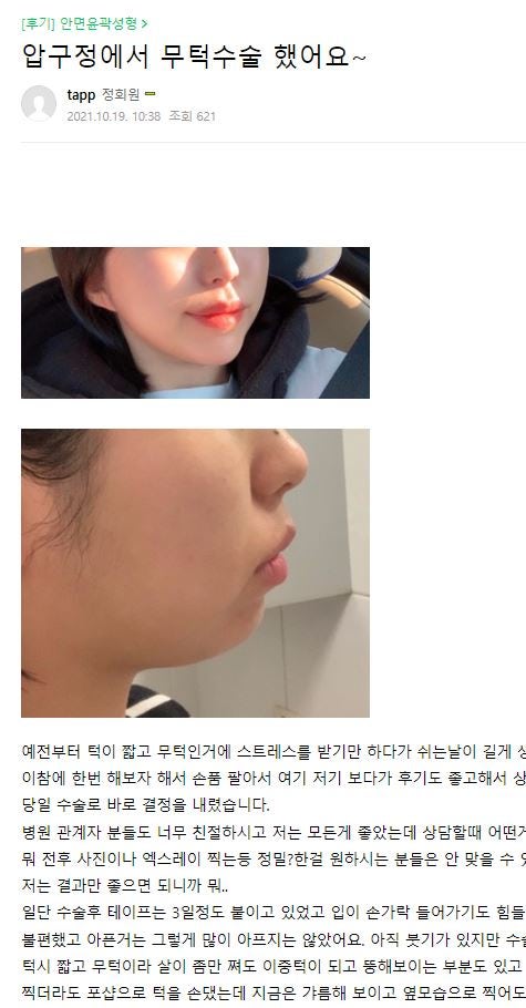 [윤곽성형] 무턱탈출, 이제 압구정서울성형외과에서! 관련 이미지 6