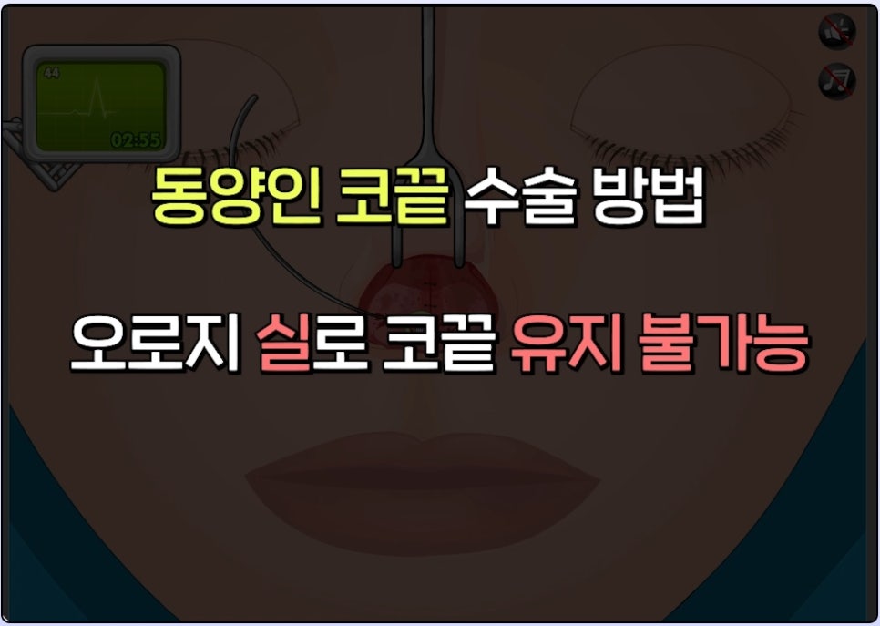 매부리코 코수술 게임 후기 및 비중격연골 매부리 코수술 방법 코수술 진행 과정 압구정서울성형외과 관련 이미지 20