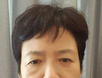 A Dramatic Transformation for Brighter, Clearer Eyes: A 5-Year Follow-Up Review of Forehead Lift Surgery in Your 60s image 2