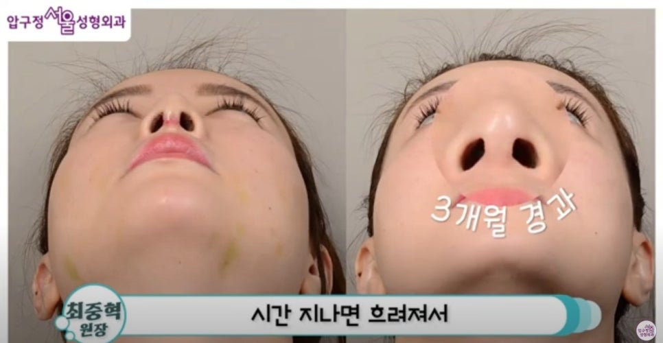 Apgujeong closed rhinoplasty: is it the right method for me? image 5