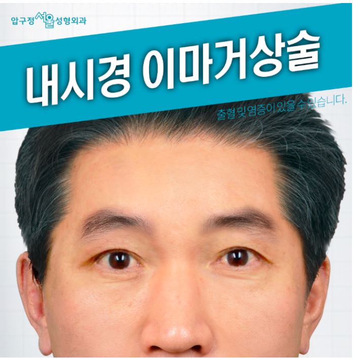 압구정서울성형외과 눈처짐+이마주름 한번에 해결! 관련 이미지 2