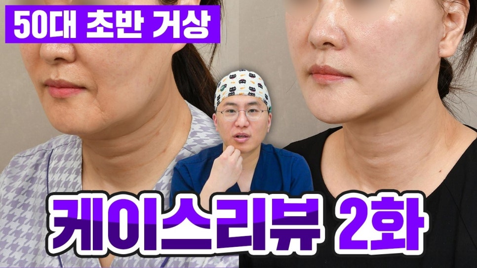 50대 안면거상 후기 팔자주름부터 목주름까지 어떻게 달라질까? 관련 이미지 1