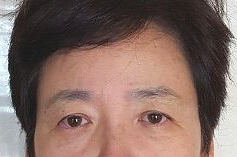 A Dramatic Transformation for Brighter, Clearer Eyes: A 5-Year Follow-Up Review of Forehead Lift Surgery in Your 60s image 11