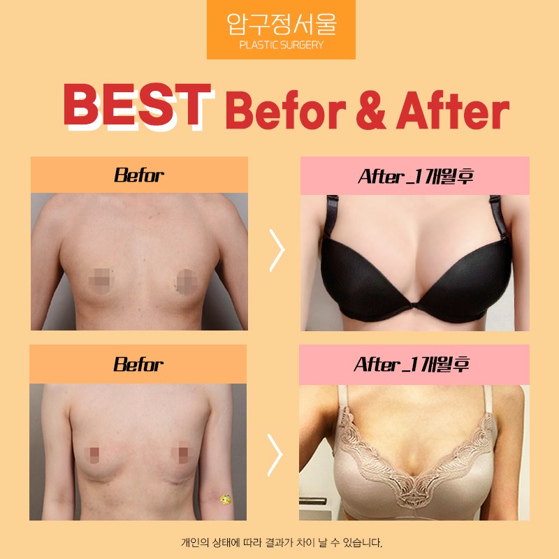 A hospital that is good at breast augmentation: experience is skill image 7