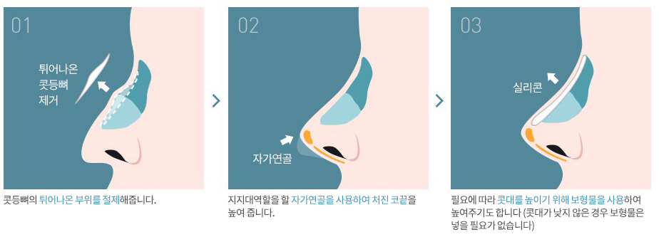 Hump Nose Correction: Straight and Beautiful image 2