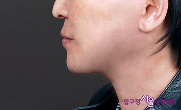 [압구정서울성형외과] 목주름과 처짐 목거상으로 깔끔한 개선! 관련 이미지 2