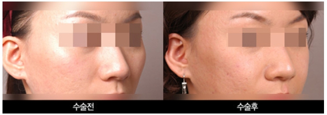 Types of Zygoma Reduction Surgery, Contour Surgery That Can Correct a Peanut-Shaped Face | Apgujeong Seoul Plastic Surgery image 6