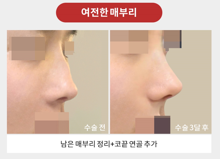 Revision Rhinoplasty Plastic Surgery: Female and Male Nose Surgery at Apgujeong Seoul Plastic Surgery image 3