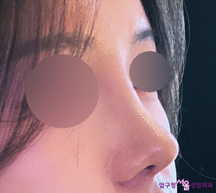 When Can Minors Preparing for College Entrance Exams Get Eye Surgery or Nose Surgery? image 13