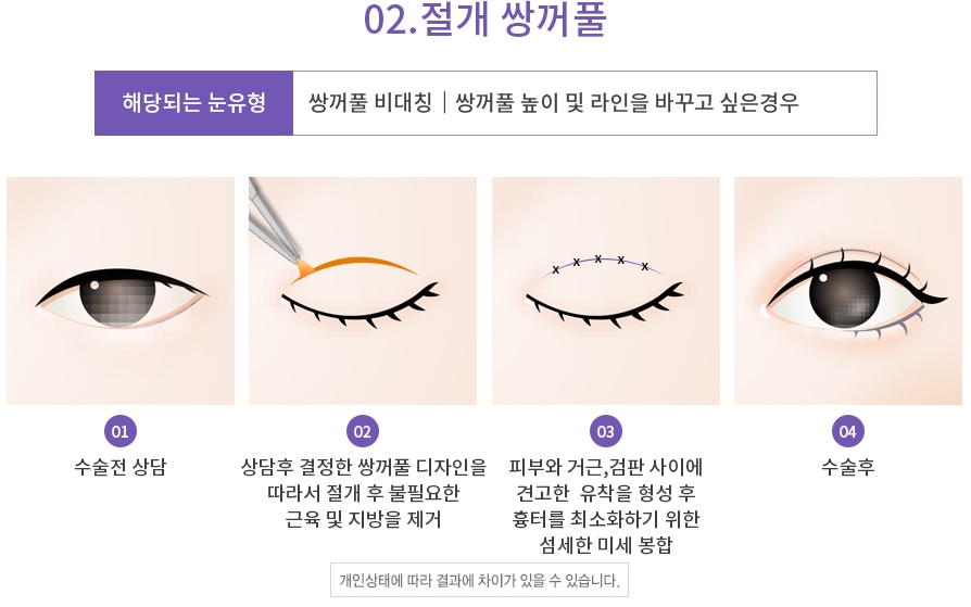 Apgujeong Seoul Plastic Surgery: Revision Eyelid Surgery Methods and Reviews by Type image 6