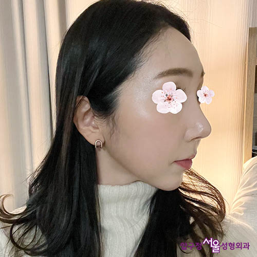 [Apgujeong Seoul Plastic Surgery] Natural Straight Line Improvement After Hump Nose Surgery! image 2