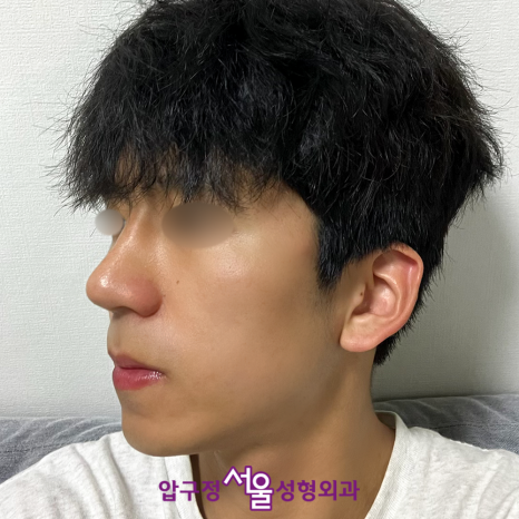 압구정서울성형외과의원 박보검 코 남자 연예인 같은 매부리코 수술 사례 관련 이미지 9